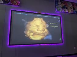 3D 4D HDLive Ultrasound - Cherished Memories