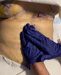 Sapphire After Lipo Therapy Miami: Lymphatic Drainage Center
